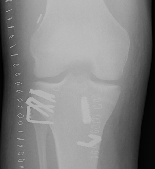 Hamstring ACL PLC Advancement